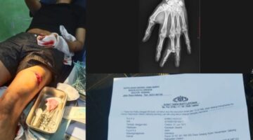 Diduga Menjadi Korban Kekerasan Bersenjata Tajam, Anak Jurnalis di Cirebon Belum Peroleh Kepastian Hukum